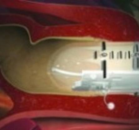 Secca